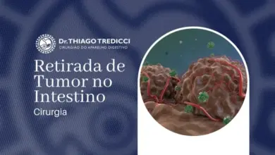 Cirurgia de Retirada de Tumor no Intestino
