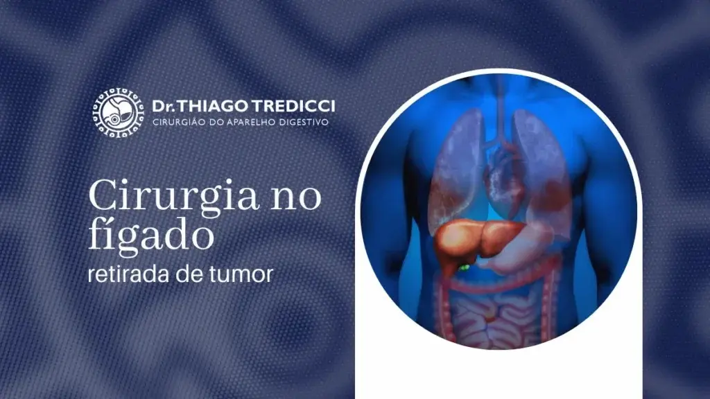 Cirurgia no fígado para retirada de tumor