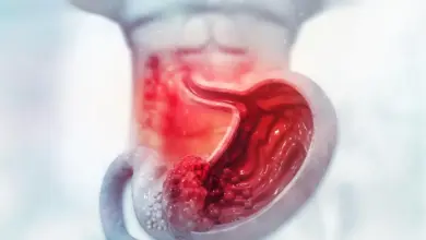 Como É a Cirurgia de Câncer No Estômago?