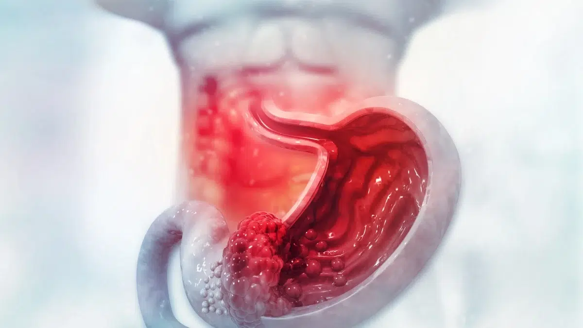 Como É a Cirurgia de Câncer No Estômago?