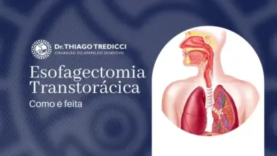 Esofagectomia Transtorácica