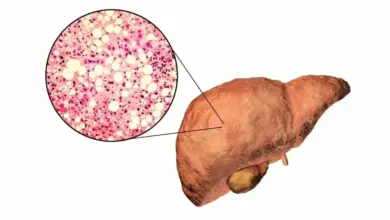 Hemangioma no Fígado é Grave
