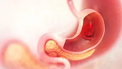 Valor De Uma Cirurgia De Câncer No Estômago?