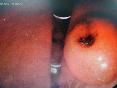 Imagem endoscópica de um tumor gástrico do tipo GIST