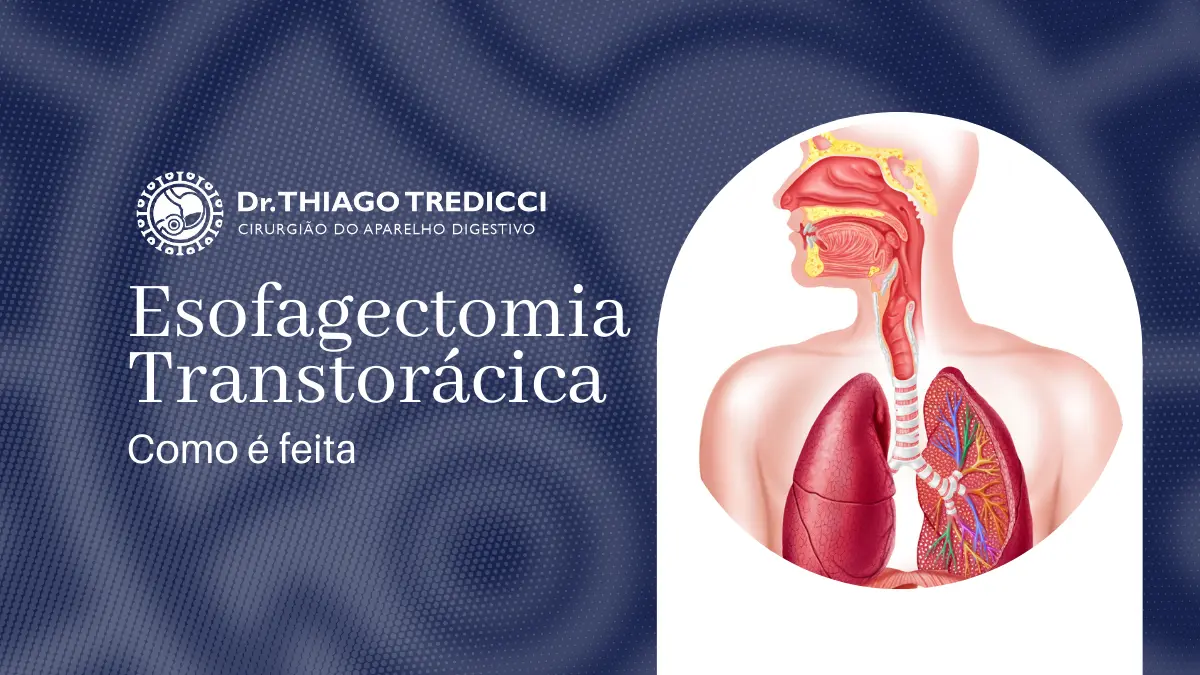Esofagectomia Transtorácica O Que é, Como é Realizada e Recuperação