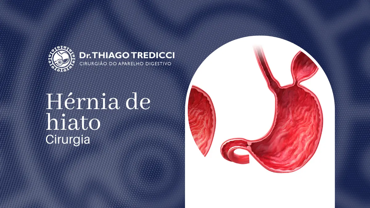 Cirurgia de hérnia de hiato Procedimento eficaz para corrigir hérnias de hiato