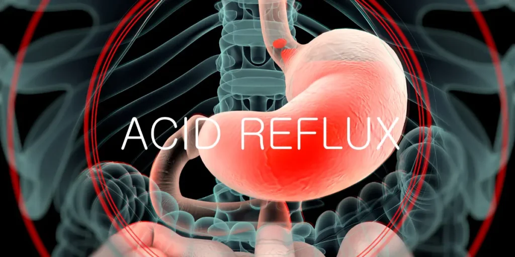 Cirurgia de Refluxo é Perigosa