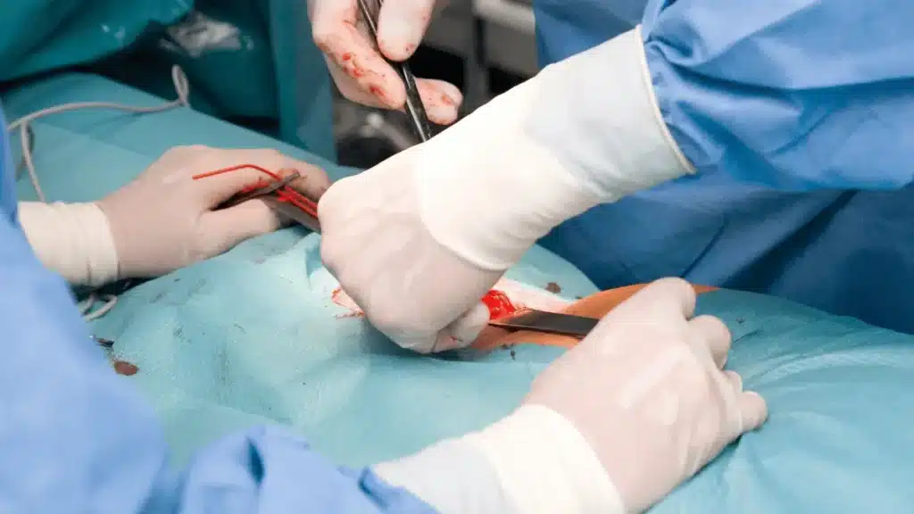 Tratamento de hérnia inguinal cirúrgico e não cirúrgico