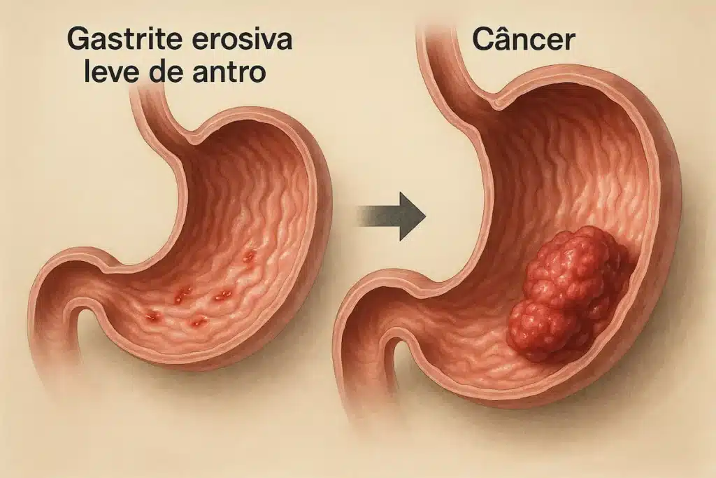 Gastrite erosiva leve de antro pode virar câncer